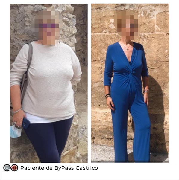 bYpASS gASTRICO copia